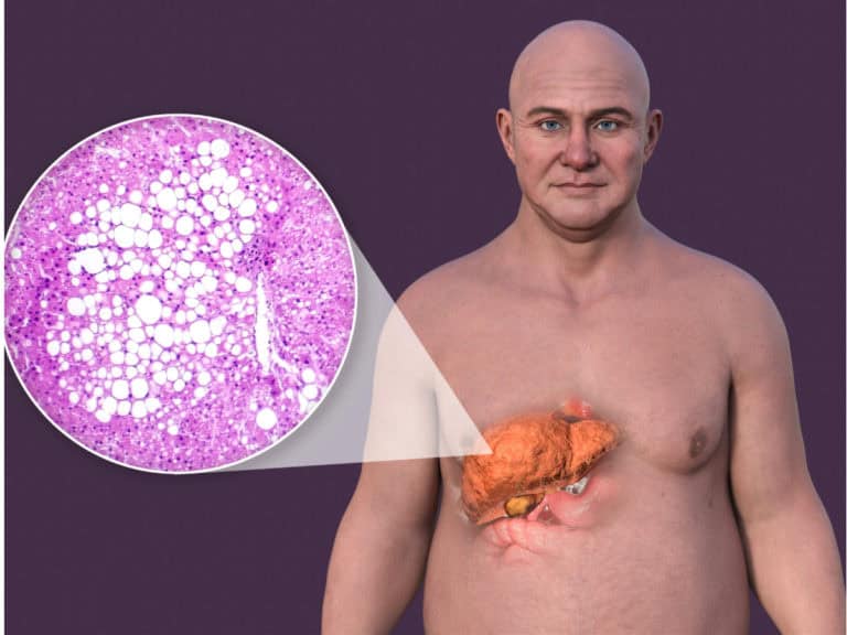 метаболитно асоциирана чернодробна болест